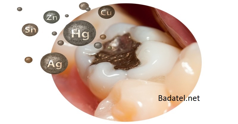 170 ročná história plombovania zubov škodlivým amalgámom