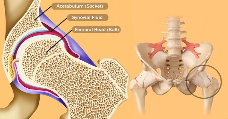 Koxartróza (Artróza) - Ako na bolesti bedrových kĺbov