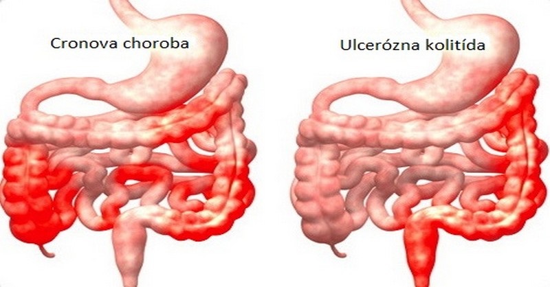 Ulcerózna kolitída a Crohnova choroba: Skutočné príčiny a prírodná liečba