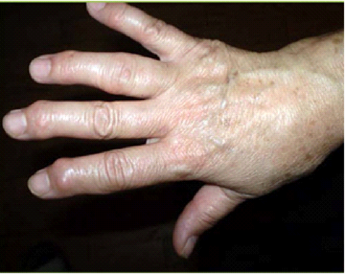 Ruka postihnutá reumatidnou artritídou