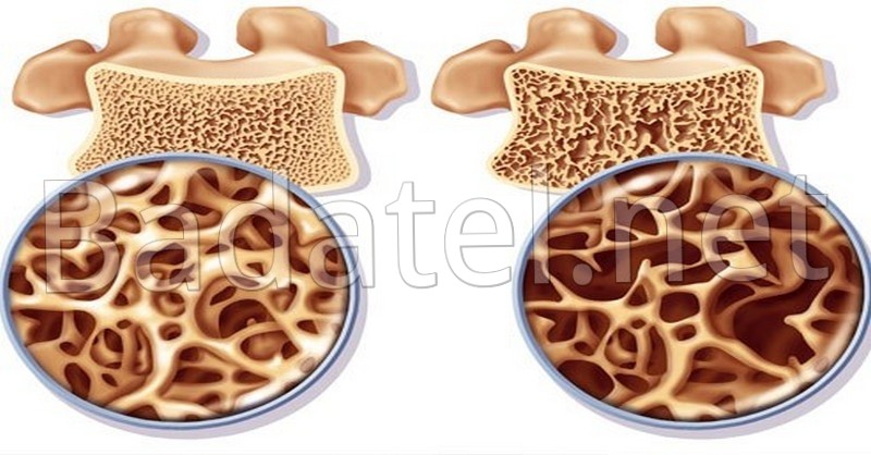 osteoporoza-a-kosti