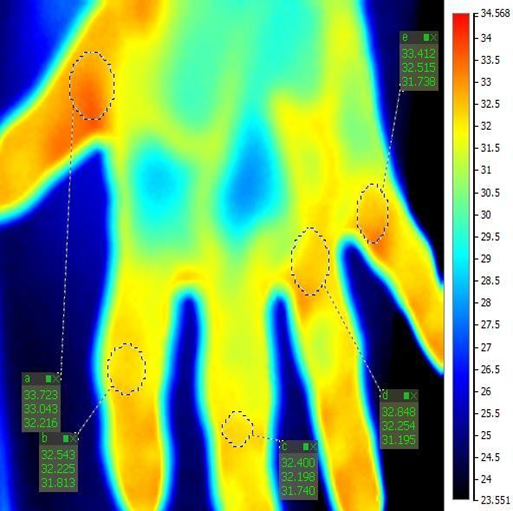 vyšetrenie ruky termokamerou