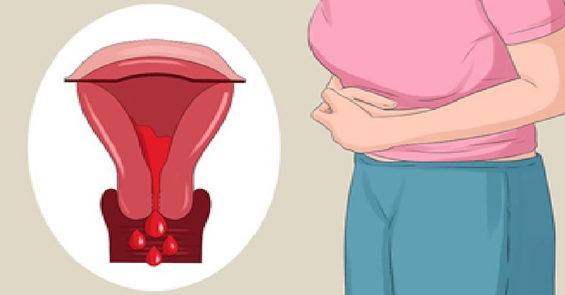 Nepravidelná menštruácia a vynechaný cyklus majú týchto 7 príčin