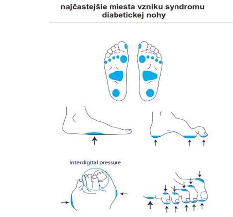 miesta vzniku vredov na nohe pri cukrovke