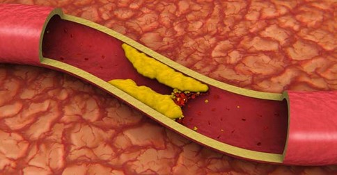 cholesterol v cievach