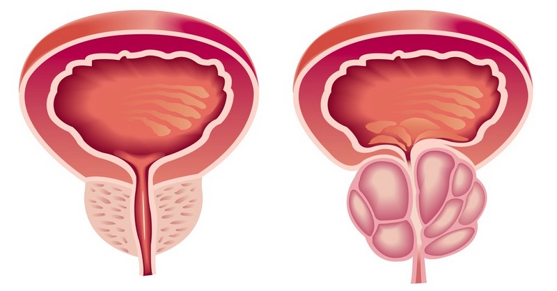 zväčšená prostata