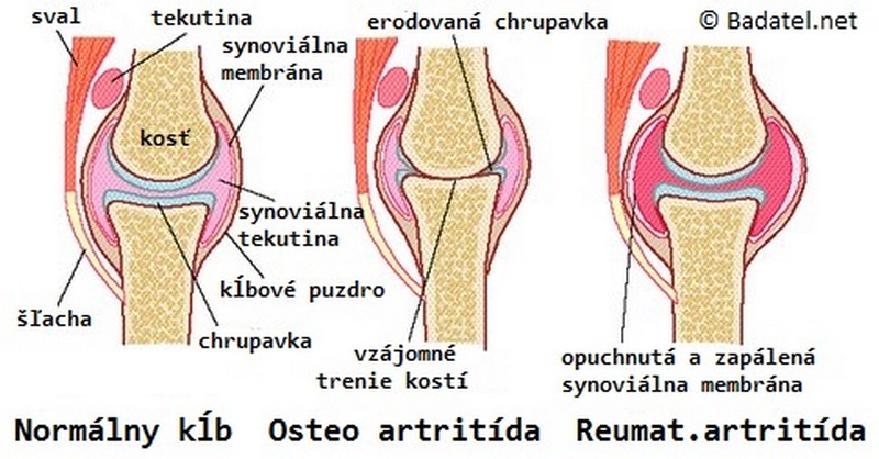 bolesti pri reume a artritíde