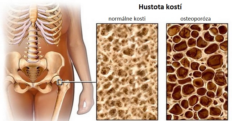 potraviny na osteoporózu