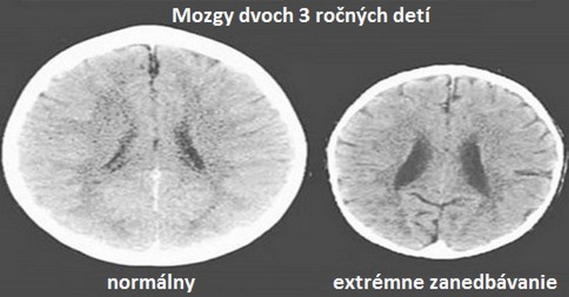 ako láska ovplyvňuje mozog