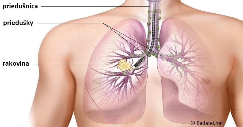 rakovina pľúc