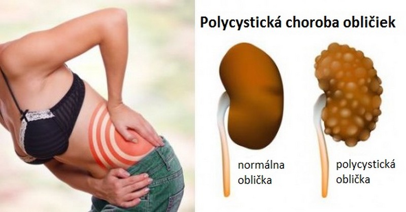 ochorenia obličiek