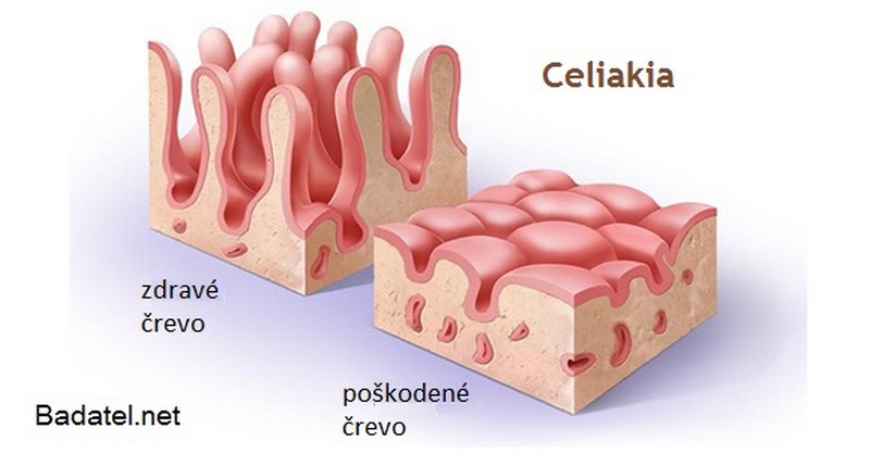 celiakia-crevo