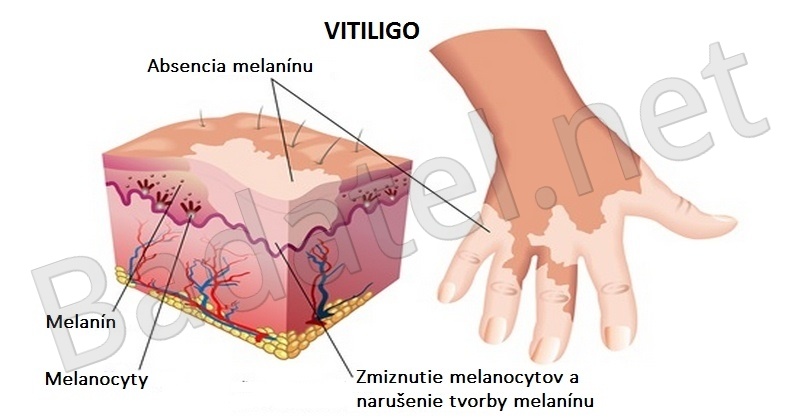 vitiligo