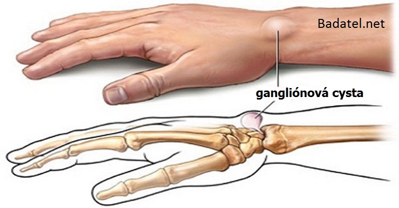 ganglionove-cysty