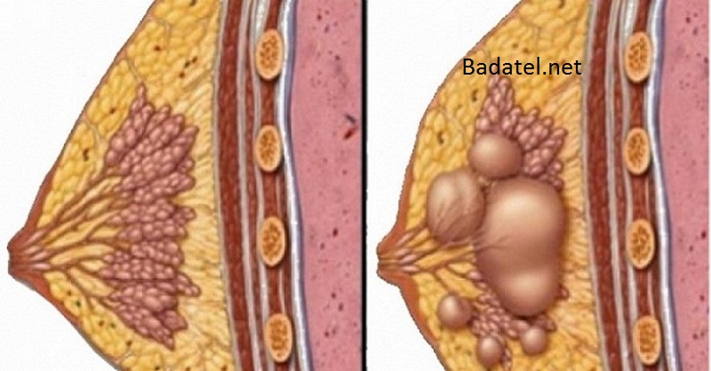 Cysta, hrčka a fibróm v prsníku majú túto najčastejšiu príčinu