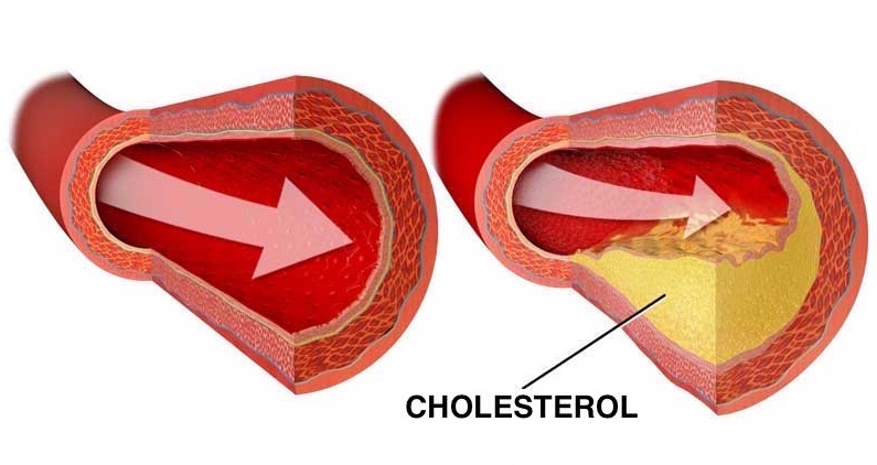 Týchto 12 potravín rozpustí a vyplaví usadený cholesterol z vašich ciev