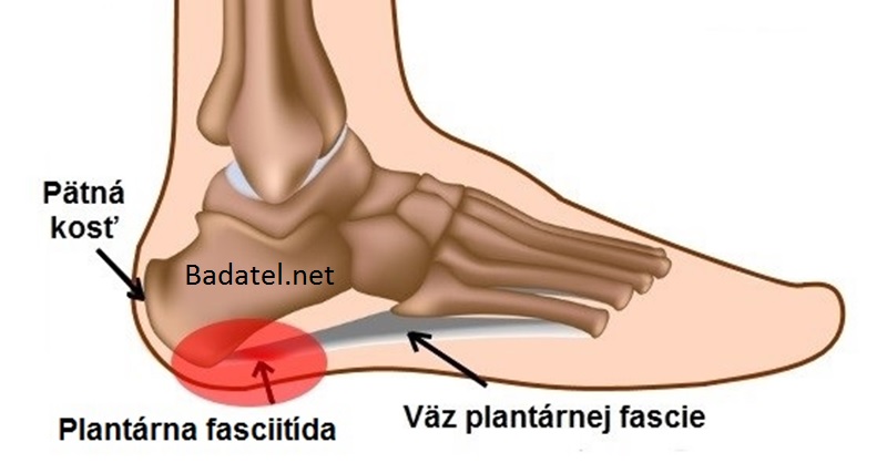 plantarna-fasciitida