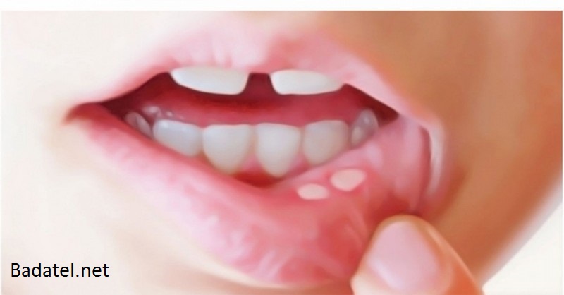 6 domácich prostriedkov, ako vyliečiť bolestivé afty v ústach