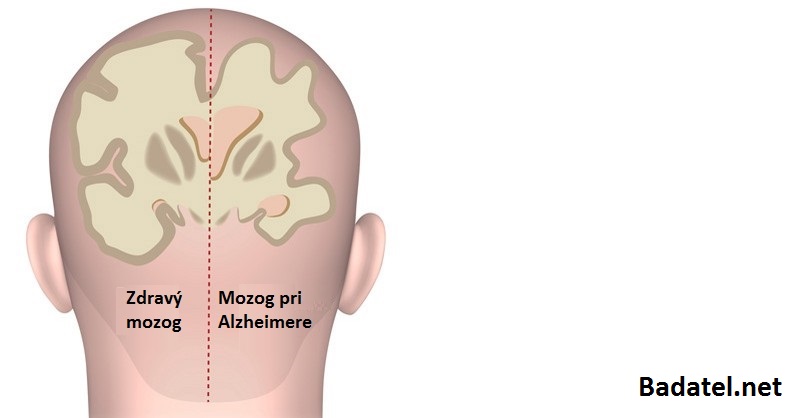 9 vecí, ktoré musíte urobiť dnes, aby ste sa vyhli demencii a Alzheimerovej chorobe neskôr