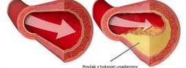 Dostupný enzýmový výživový doplnok, ktorý prečisťuje tepny, pomáha pri liečbe syndrómu karpálneho tunela, fibrocystickej choroby prsníka, problémov s pľúcami a odstraňuje mnohé iné zdravotné problémy