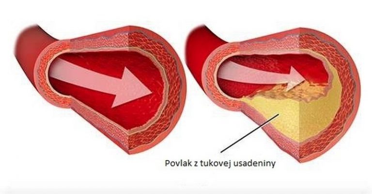 Dostupný enzýmový výživový doplnok, ktorý prečisťuje tepny, pomáha pri liečbe syndrómu karpálneho tunela, fibrocystickej choroby prsníka, problémov s pľúcami a odstraňuje mnohé iné zdravotné problémy