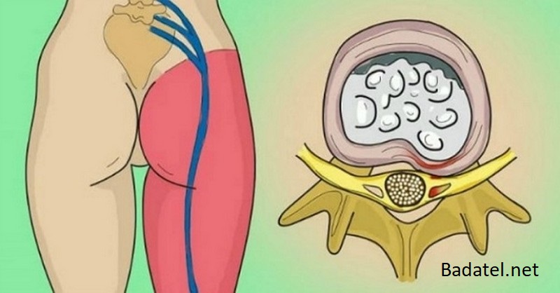5 prírodných spôsobov ako uvoľniť zaseknutý sedací nerv a zbaviť sa bolestí