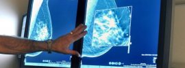Najväčšia a najdlhšie trvajúca štúdia zistila, že mamografy nemajú žiaden prínos