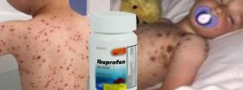 Nikdy nedávajte deťom ibuprofen, keď majú kiahne
