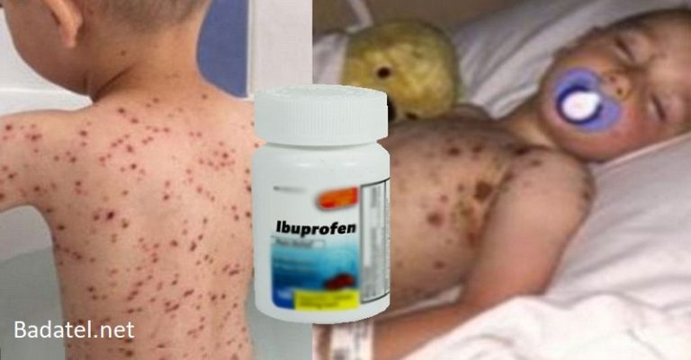 Nikdy nedávajte deťom ibuprofen, keď majú kiahne