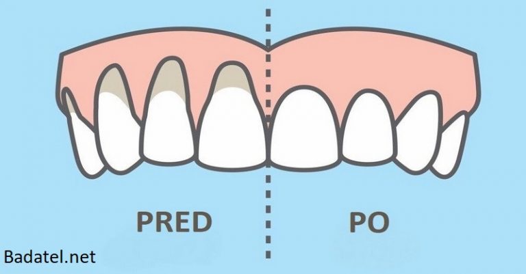 10 jednoduchých a prírodných spôsobov ako liečiť ustupujúce ďasná