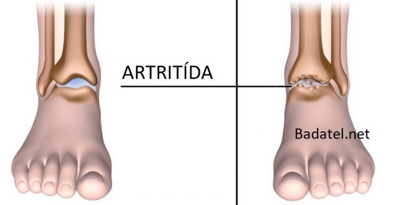 5 potravín, ktoré pomôžu znížiť bolesť spôsobenú artritídou