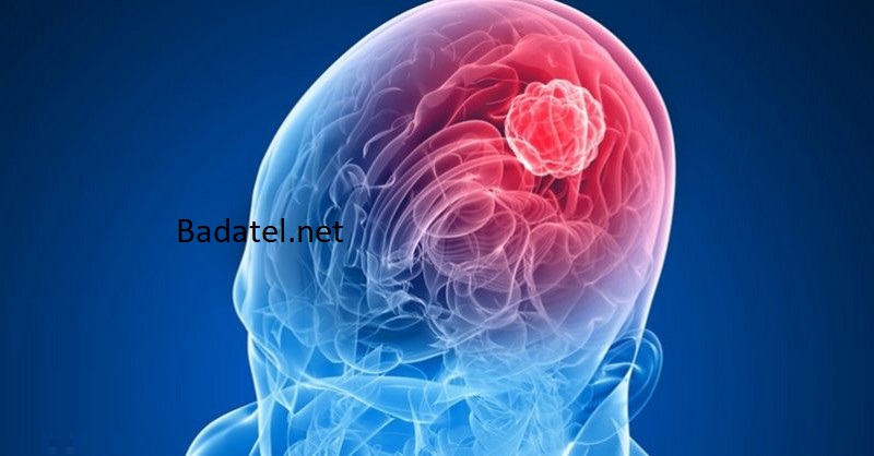 7 najčastejších príznakov nádoru na mozgu