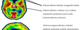 Záchvaty paniky a úzkosť súvisia s nízkymi hladinami vitamínu B a železa