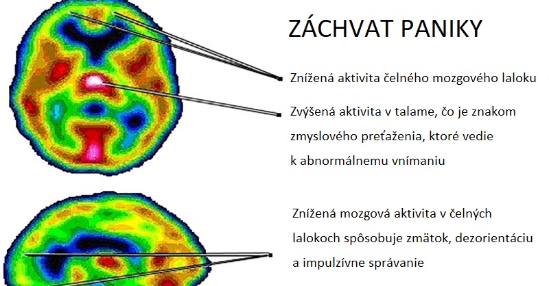 Záchvaty paniky a úzkosť súvisia s nízkymi hladinami vitamínu B a železa