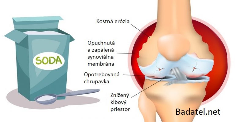 Ako používať sódu bikarbónu na zmiernenie bolesti pri artritíde
