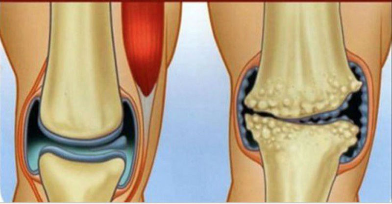 dureri articulare la nivelul piciorului decât la tratament umflarea cu deteriorarea ligamentelor articulației gleznei
