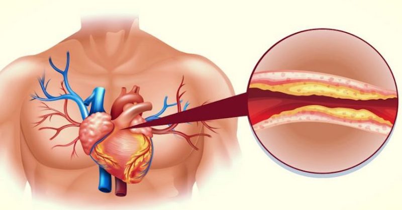 Koniec vysokému cholesterolu a upchatým cievam (prírodná liečba)