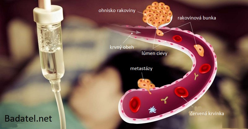 Chemoterapia šíri rakovinu