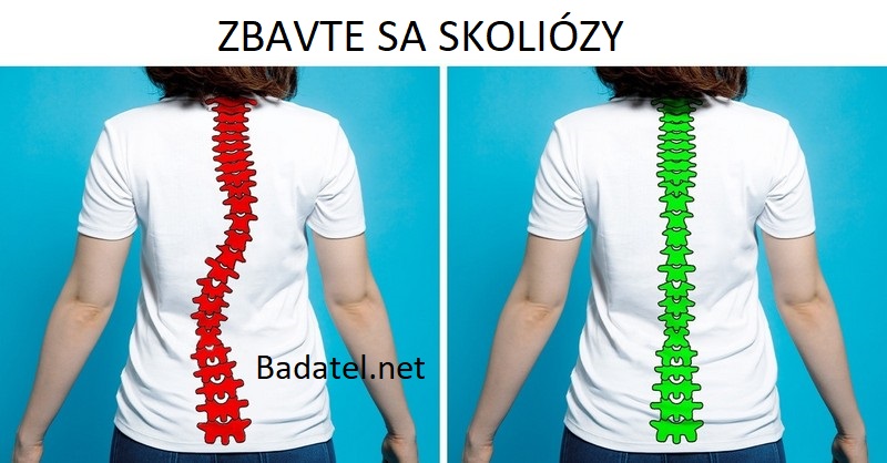 Ako si za 10 minút denne zlepšiť držanie tela a vyhnúť sa skolióze