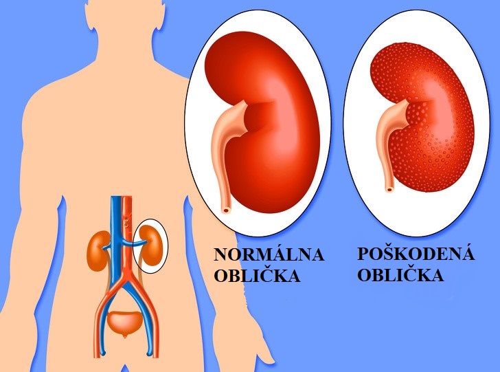 8 nebezpečenstiev tabletiek na chudnutie, ktoré by sme nemali ignorovať