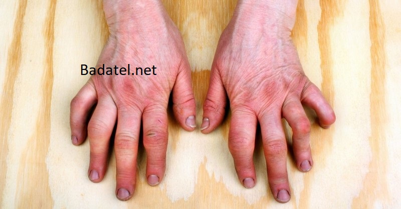Príčina autoimunitných ochorení ako je reumatoidná artritída by mohla byť vo vašej chladničke
