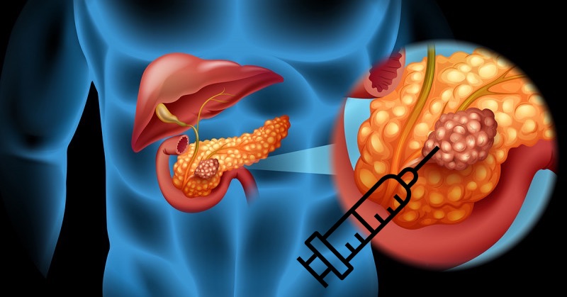 Výskyt rakoviny pankreasu explodoval po tom, čo covidové vakcíny rozniesli hrotové proteíny do vitálnych orgánov