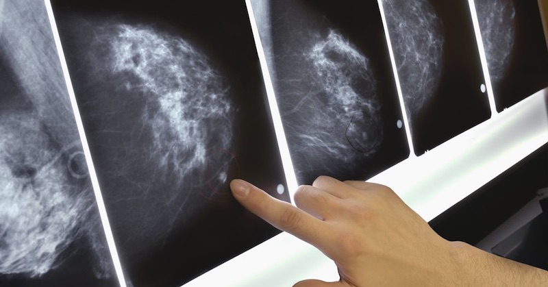 Medicínsky priemysel tlačí stále mladšie ženy do rizikových mamografických vyšetrení