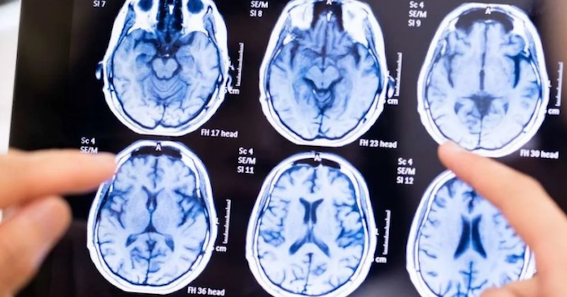 Vedci zistili, že Alzheimerova choroba je spôsobená hubovitou infekciou v mozgu