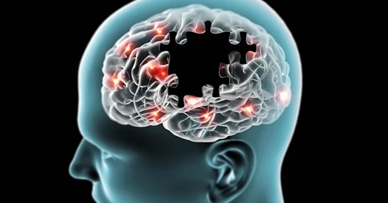 Prelomová štúdia objavila viacero chýbajúcich živín v mozgoch pacientov s Alzheimerom