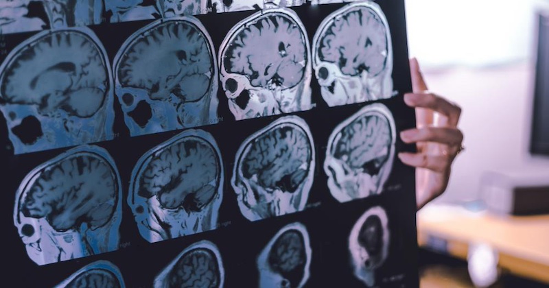 Hladina lítia v mozgu pacientov s Alzheimerom je nižšia o 60%. Môže táto zabudnutá živina zvrátiť demenciu?