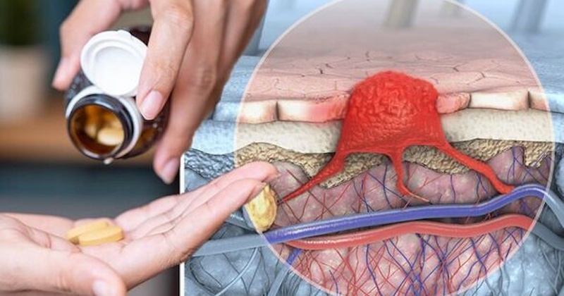Nový výskum zistil, že bežný vitamín dokáže až o polovicu znížiť riziko rakoviny kože