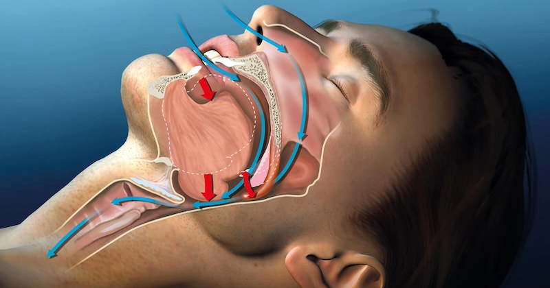 Tichý sabotér vášho zdravia: Ako nočné dýchanie ústami podrýva váš spánok, imunitu a mozog