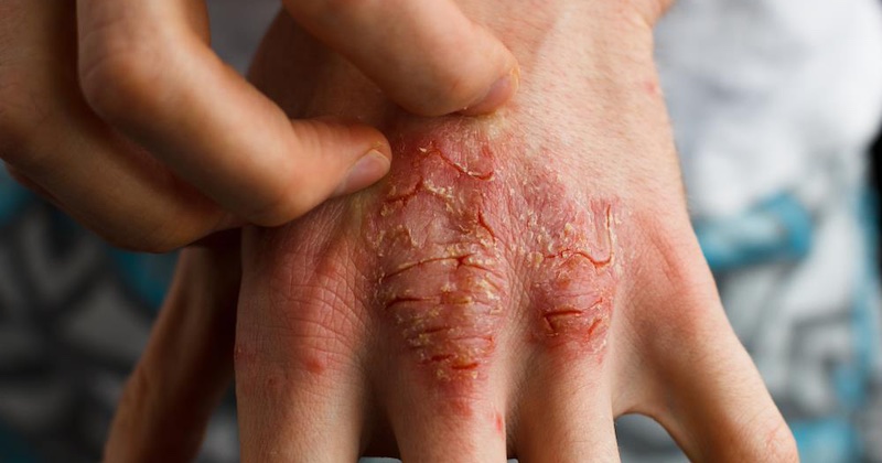 Ide o viac než len svrbenie: Pri liečbe ekzémov je nutné zmeniť stratégiu