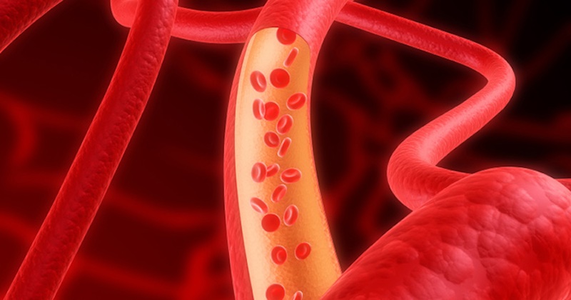 Nielen zlá strava, ale aj niektoré látky vo vzduchu vám môžu spôsobiť kôrnatenie a upchávanie ciev
